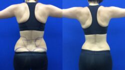 Laser Lipo Before and After Results: What to Expect at Allure Clinic