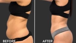 Laser Lipolysis Before and After: Understanding Results and Recovery