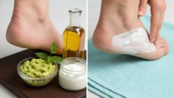 Heal Dry Cracked Heels Faster at Home Using Powerful Kitchen Ingredients That Deliver Visible Results